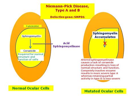 Niemann-Pick Disease, Types A and B | Hereditary Ocular Diseases