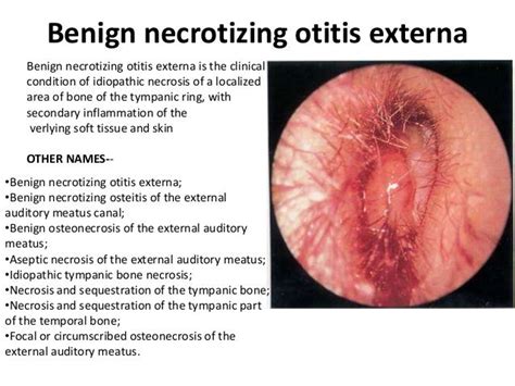 otitis externa treatment - pictures, photos