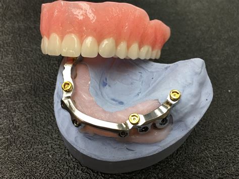 What is the difference between bar overdenture and locator overdenture? | News | Dentagama