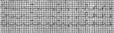 Dr. Smith's ECG Blog: Cardiac arrest with anterior-inferior STEMI ...