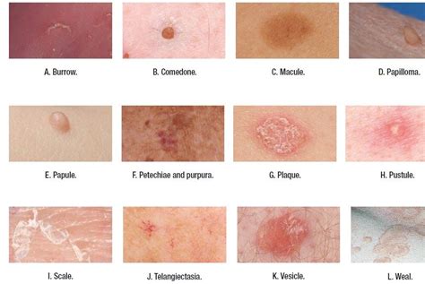 Medical Addicts: Terms used to describe skin lesions | Dermatology nurse, Skin ulcer, Skin ...