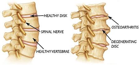 Cervical Osteoarthritis (Spondylosis) Treatment Texas