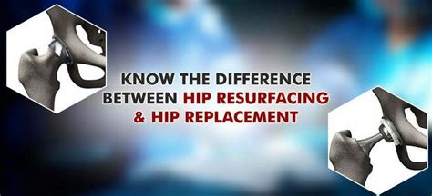 Difference B/W Hip Resurfacing & Hip Replacement Surgeries | AH