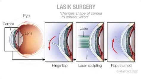 Mayo Clinic Q and A: LASIK eye surgery - understanding the risks and ...