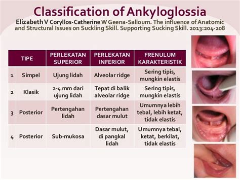 Diagnosis tongue tie & indikasi frenektomi