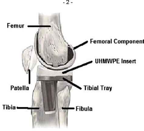 [PDF] Wear measurement of polyethylene components in total knee replacement | Semantic Scholar