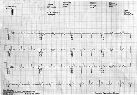 Transient Left Bundle Branch Block During the Recovery Period of a Stress Test - Open Access Pub