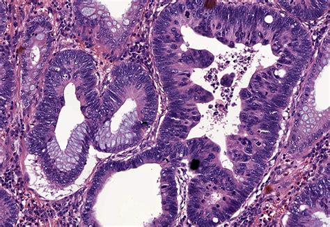 Tubular Adenoma Histology