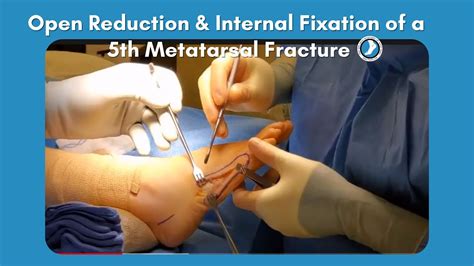 Open Reduction Internal Fixation Of A 5th Metatarsal, 53% OFF