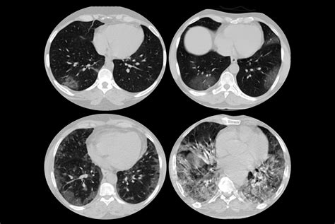 COVID-19 and chest CT | IAEA