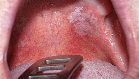 Leukoplakia: Symptoms, causes, and prevention