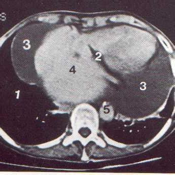 Aspiration cytology smear of centrifuged pericardial fluid showing ...