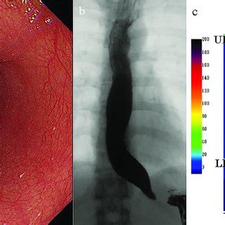 (a) On endoscopy, the esophagus looks normal without dilation. However,... | Download Scientific ...