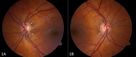 Multiple and Bilateral Cilioretinal Arteries with Shwachman-Diamond ...