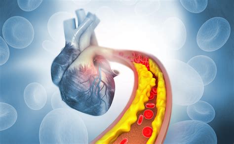 High cholesterol: what it means, what causes it and how to reduce your levels | Yorkshire ...