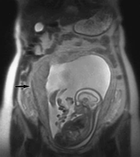 Normal Anatomy of the Fetus at MR Imaging | RadioGraphics