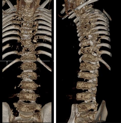 Disseminated tuberculosis – Radiology Cases