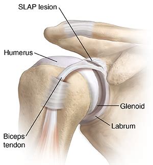 SLAP Lesion of the Shoulder Joint | Saint Luke's Health System