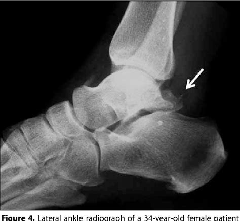 Figure 9 from The Accessory Ossicles of the Foot and Ankle; a Diagnostic Pitfall in Emergency ...