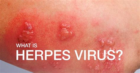 All You Need To Know About Herpes Simplex Virus | Marham