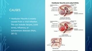 Vestibular neuritis | PPT