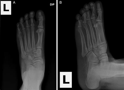 Autoamputation of the fifth digit: ainhum (dactylolysis spontanea) | BMJ Case Reports