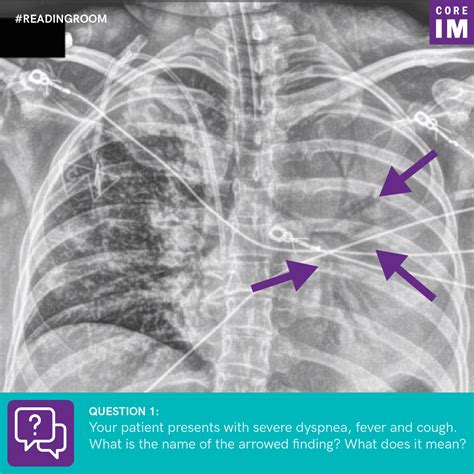 What is the name of the arrowed finding on this chest x-ray and what does it mean? | Core IM Podcast