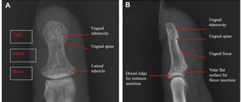 Review of Distal Phalanx Fractures - Sports Medicine Review