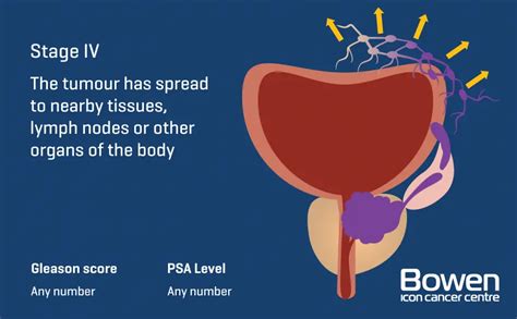 What is Prostate Cancer? Prostate Cancer Explained — Bowen Icon Cancer Centre