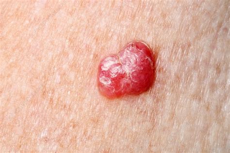 Malignant melanoma skin cancer - Stock Image - C037/0932 - Science ...