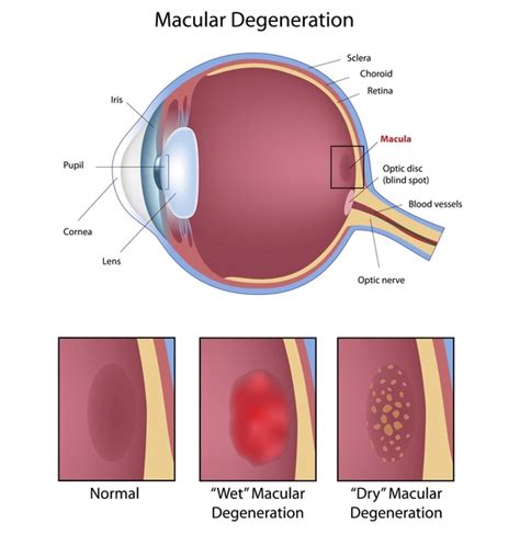 Stargardt macular degeneration: MedlinePlus Genetics