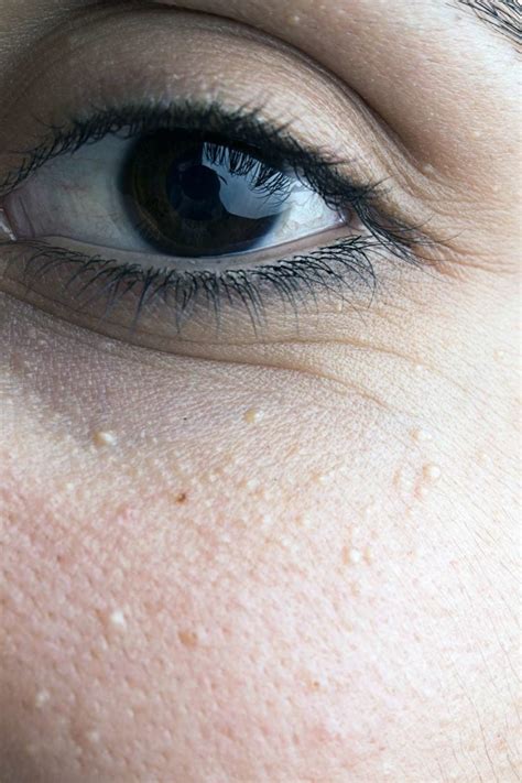 White Dots Under Eyes Not Milia / Eyelid Bumps 101 How To Identify Styes Milia Pimples Allure ...