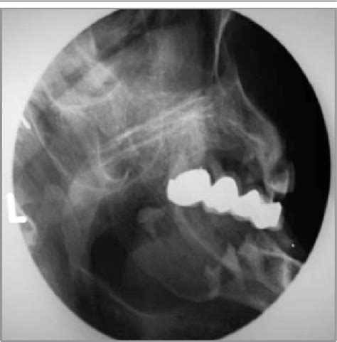 Figure 2 from The use of lateral oblique radiographs in dental treatment planning for patients ...