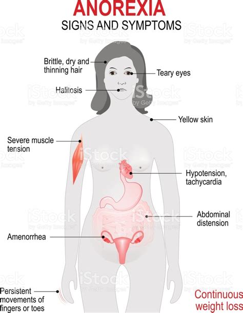 sign symptoms anorexia nervosa