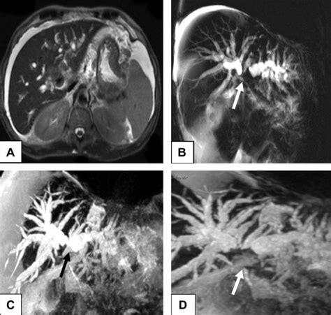 Klatskin tumor in 48-years-old male patient. (A) Ill-defined ...