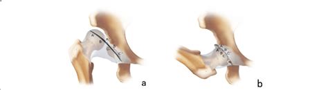 a Schematic diagram of the hip joint capsule incision before reduction ...