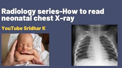 Neonatal radiology-how to read chest X-ray in neonates. The basics. # ...