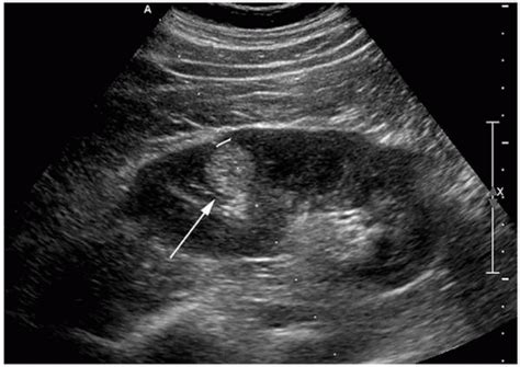 Kidney Ultrasound Tumor