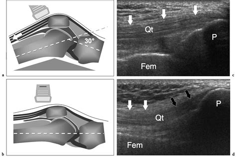 ultrasound-of-the-musculoskeletal-system-knee-2 - NYSORA