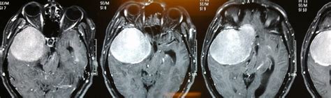 Meningioma: symptoms, diagnosis and treatment of meningioma ⚕️ MedTour