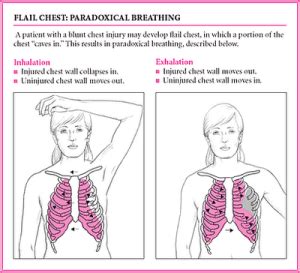 paradoxical: paradoxical breathing