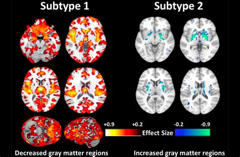 Researchers Discover Second Type of Schizophrenia - Penn Medicine