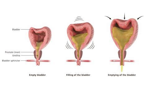 Bladder paralysis