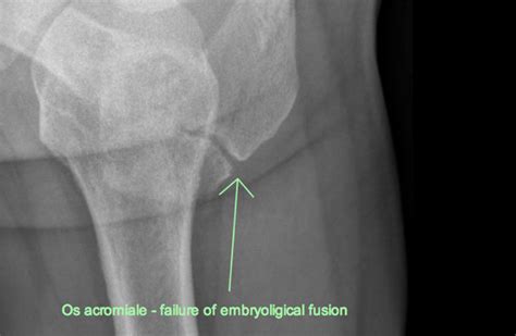 Os Acromiale - the importance of the axillary lateral x-ray - BallaratOSM | Ballarat ...