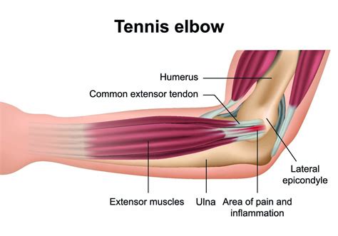 Tennis Elbow Treatment Singapore | Orchard Health Clinic