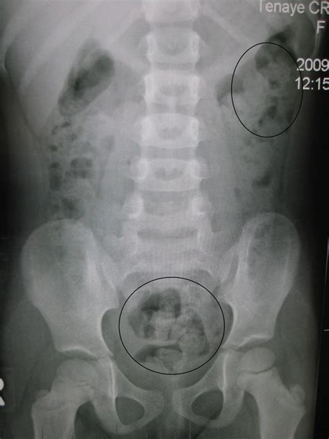 Constipation-X-ray-image - Theayurveda