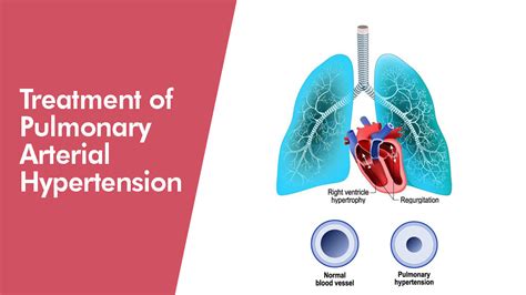 TREATMENT OF PULMONARY ARTERIAL HYPERTENSION - German Heart Centre