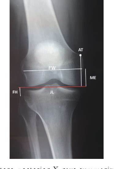 Figure 2 from The reliability of adductor tubercle as an anatomical landmark for joint line ...