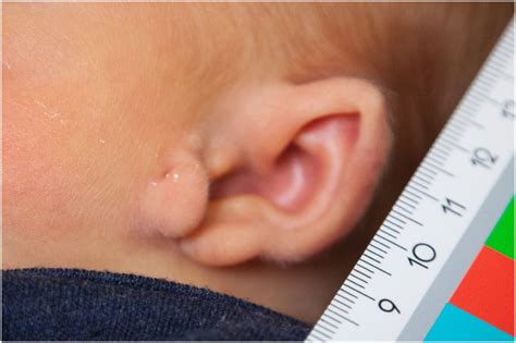 Unilateral macrostomia in the newborn: a rare congenital anomaly of the oral commissure | BMJ ...