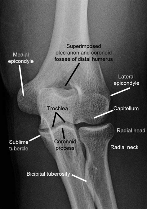 Imaging of Elbow Fractures and Dislocations in Adults | Human anatomy ...